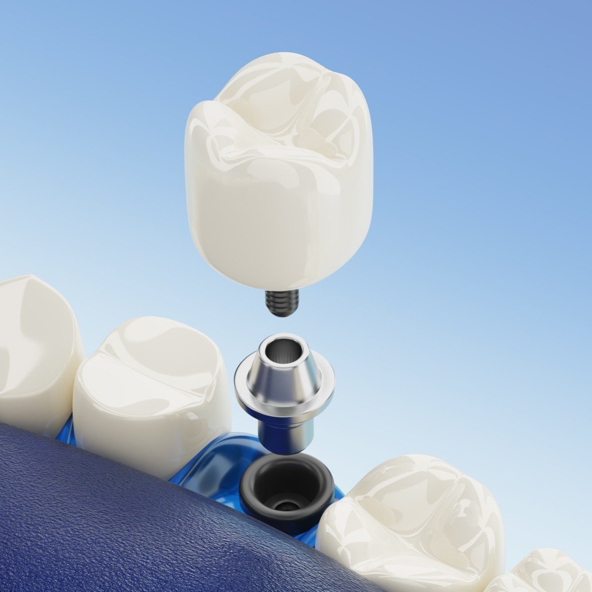 Dental Implants, New Jersey, Netcong Dental Implants, New Jersey, Netcong