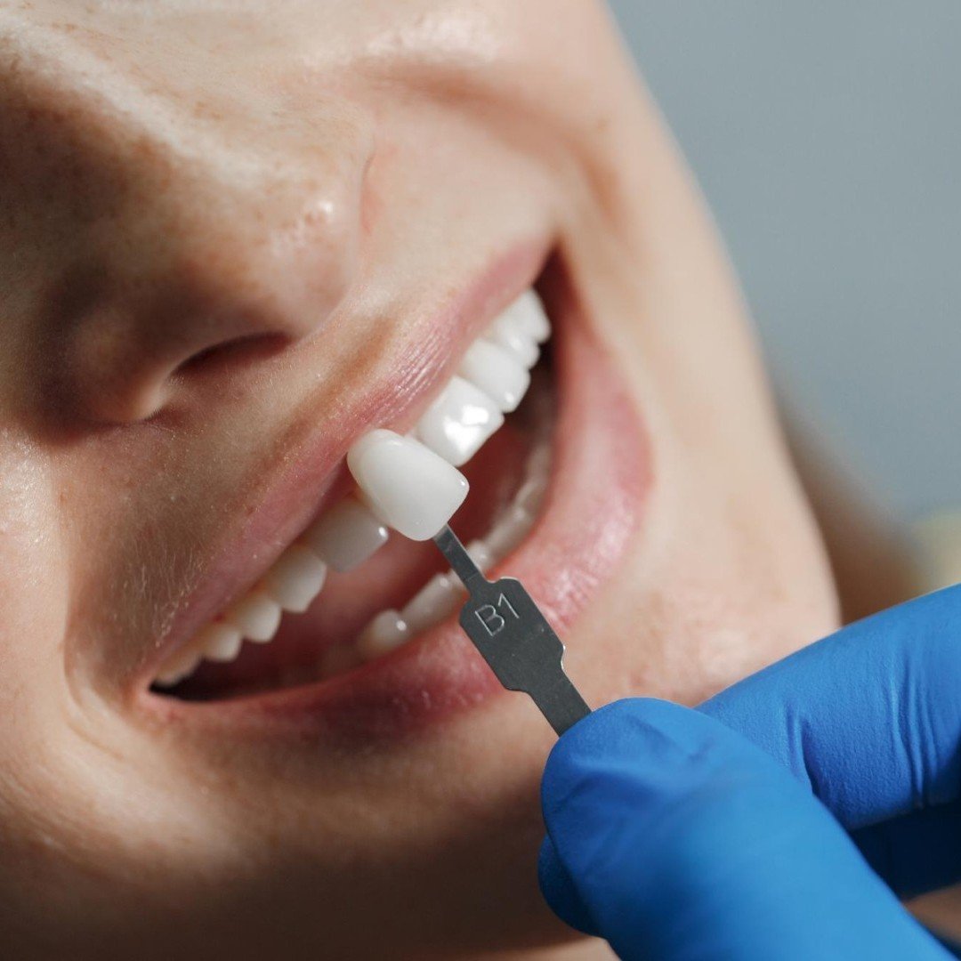 Porcelain Veneers Example, Hackettstown, NJ