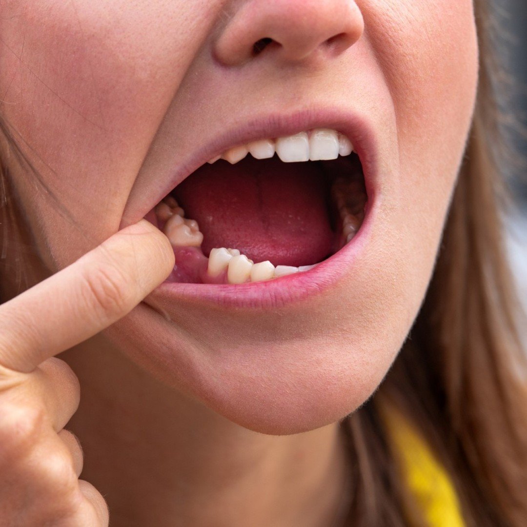 Who needs to visit dentist - Hackettstown Dental Extraction Procedure Hackettstown NJ