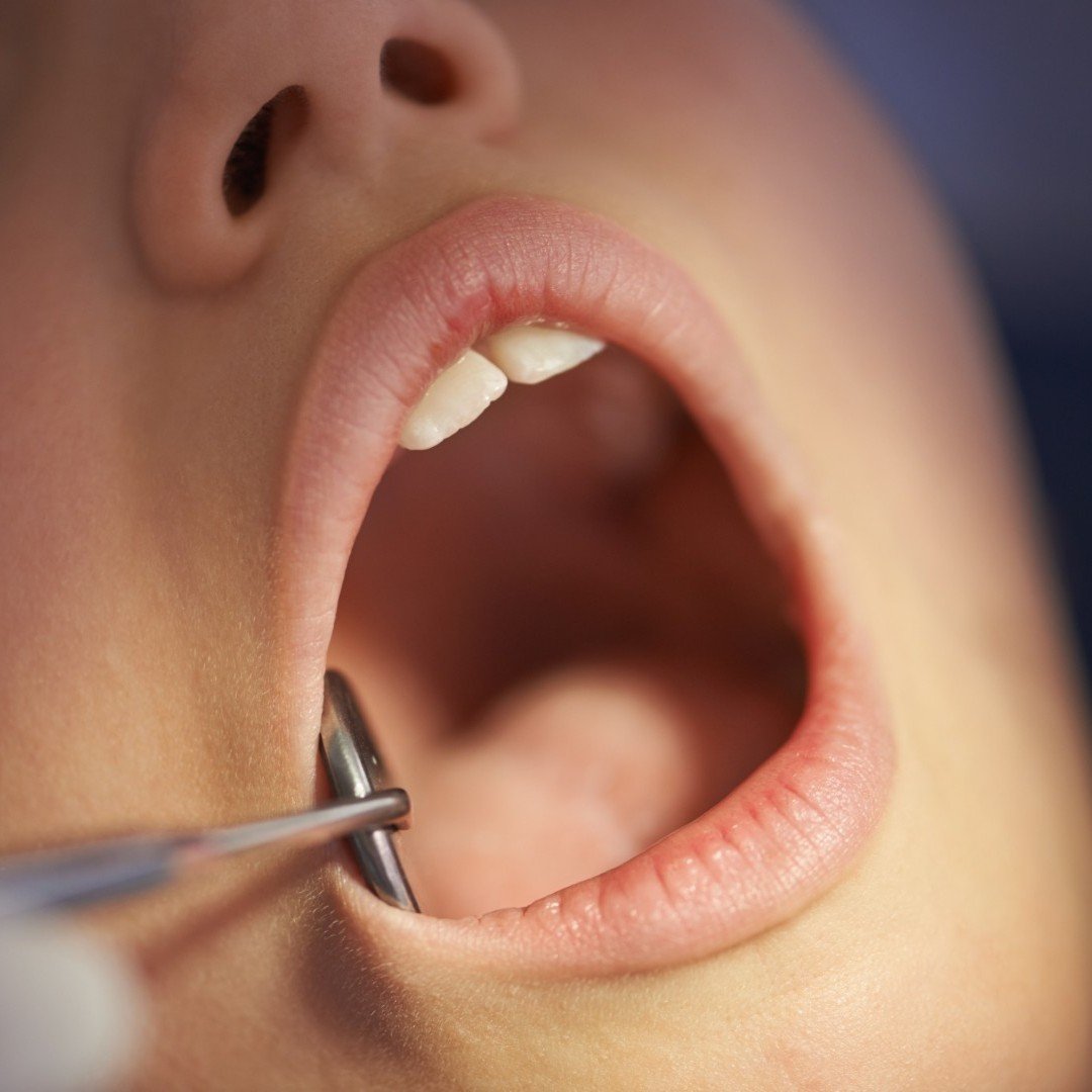 dentist visit checkup - New Jersey Dental Tools for Oral Biopsy Hackettstown NJ