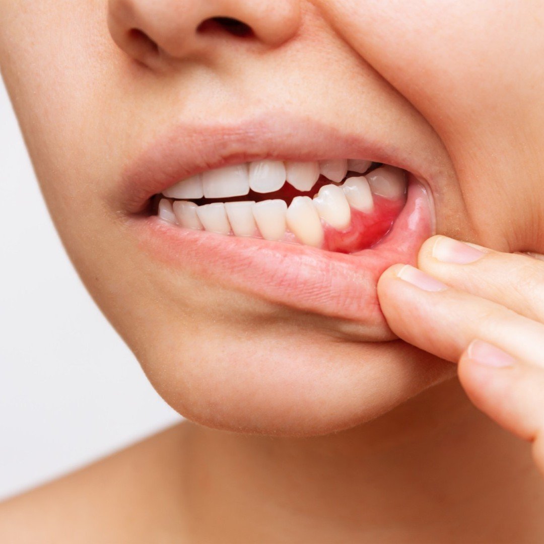 gum inflammation Oral Cancer Risk Factors Hackettstown NJ