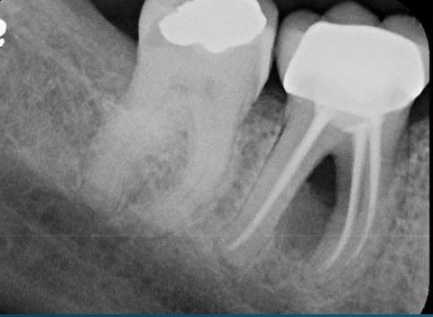 Tooth X-ray