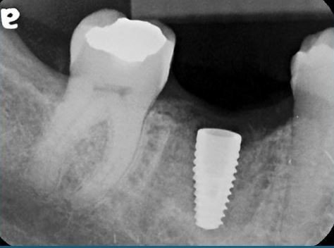 Implant X-ray