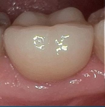 Implant