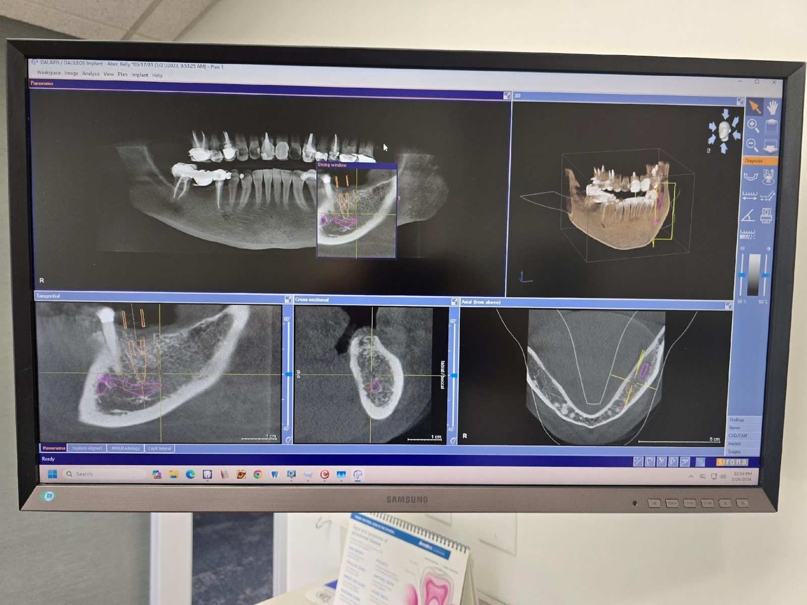 CBCT results CBCT results